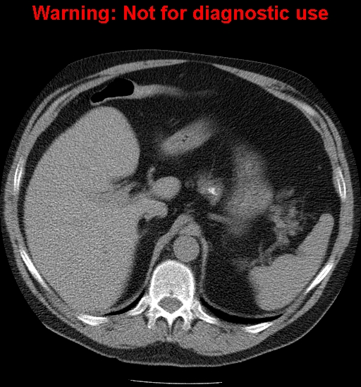 File:Bosniak renal cyst - type IV (Radiopaedia 23402-23466 Axial non-contrast 2).jpg
