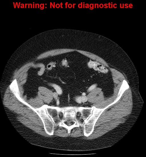 File:Bosniak renal cyst - type IV (Radiopaedia 23402-23466 D 60).jpg