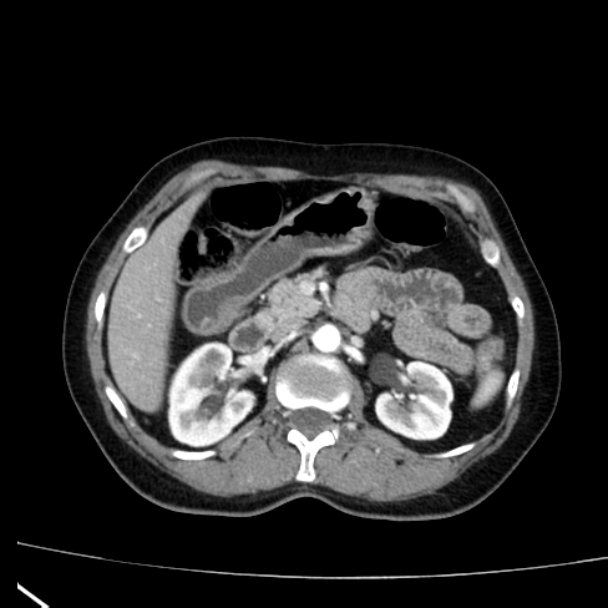 Bosniak renal cyst - type I (Radiopaedia 27479-27675 renal cortical phase 29).jpg