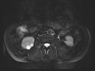 File:Bouveret syndrome (Radiopaedia 61017-68856 Axial MRCP 43).jpg