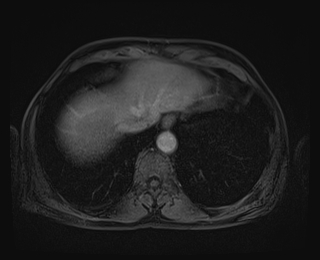 File:Bouveret syndrome (Radiopaedia 61017-68856 Axial T1 C+ fat sat 9).jpg