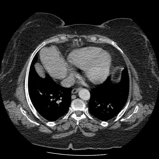Bovine aortic arch - right internal mammary vein drains into the superior vena cava (Radiopaedia 63296-71875 A 111).jpg