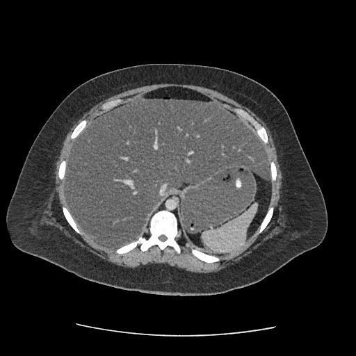 Bowel and splenic infarcts in acute lymphocytic leukemia (Radiopaedia 61055-68915 A 33).jpg