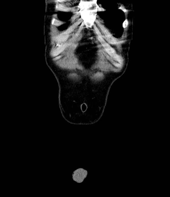Bowel obstruction from colon carcinoma (Radiopaedia 22995-23028 C 3).jpg