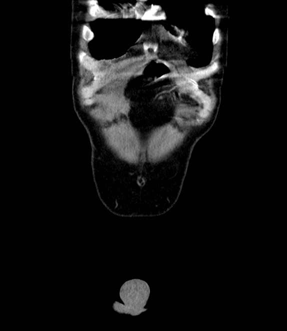 Bowel obstruction from colon carcinoma (Radiopaedia 22995-23028 C 5).jpg