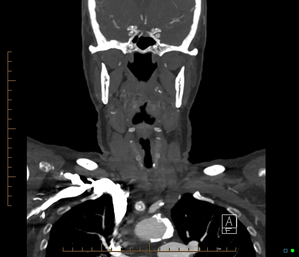 Brachiocephalic trunk stenosis (Radiopaedia 87242-103519 B 30).jpg
