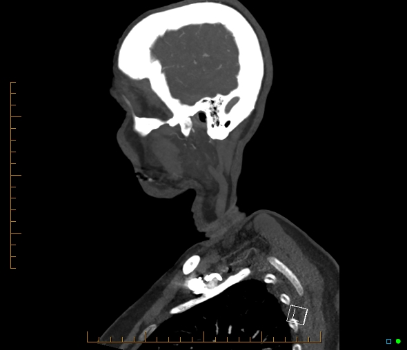 Brachiocephalic trunk stenosis (Radiopaedia 87242-103519 C 59).jpg