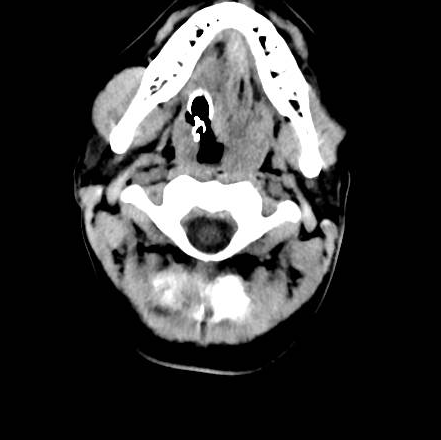 File:Brain death after motor vehicle collision (Radiopaedia 88470-105114 Axial 30).png
