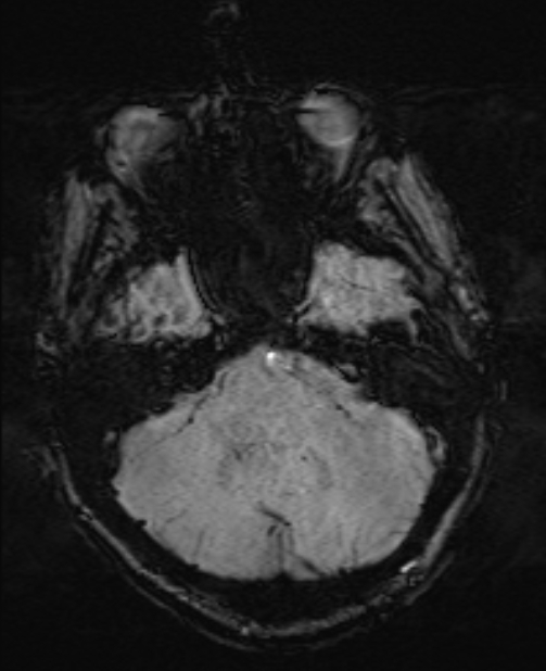 Brain metastases - lung cancer primary (Radiopaedia 75060-86115 Axial SWI 15).jpg
