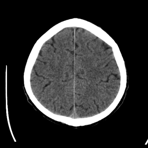 Brain metastases from lung cancer (Radiopaedia 24480-24781 Axial non-contrast 38).jpg