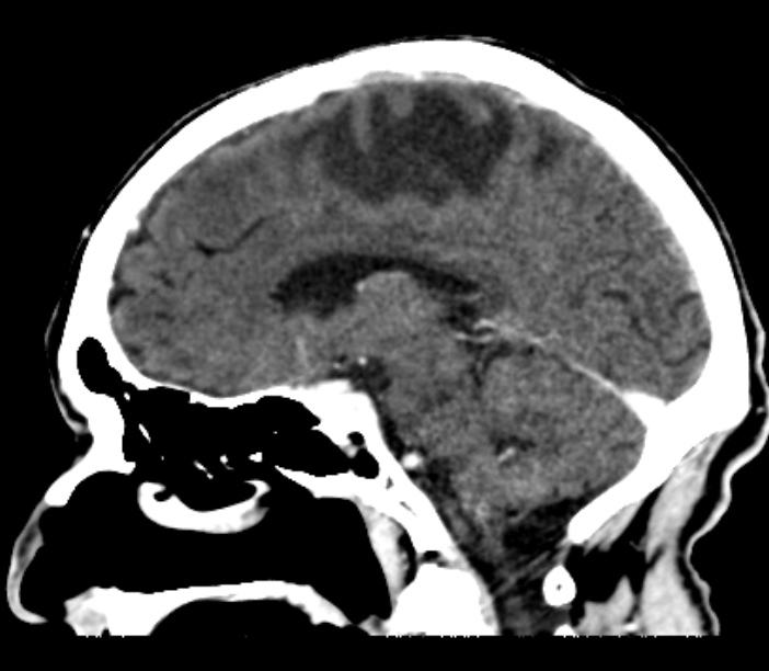 Brain metastases from lung cancer (Radiopaedia 27849-28092 Sagittal C+ delayed 29).jpg