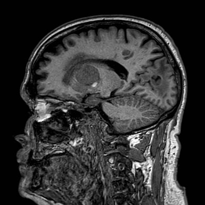 Brain metastases from lung cancer (Radiopaedia 83839-99028 Sagittal T1 50).jpg