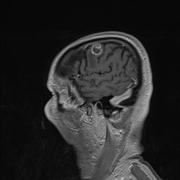 Brain metastasis (Radiopaedia 42617-45761 Sagittal T1 C+ 15).jpg