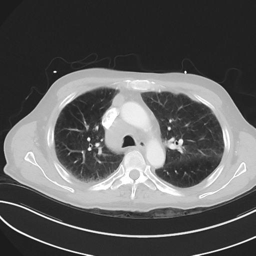File:Brain metastasis from lung cancer (Radiopaedia 48289-53180 Axial 76).png