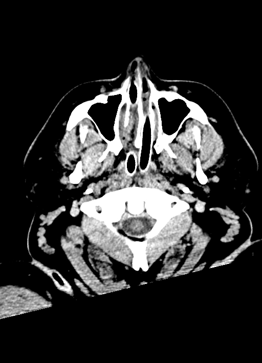 Brainstem hemorrhage (Radiopaedia 81294-94976 Axial non-contrast 63).jpg