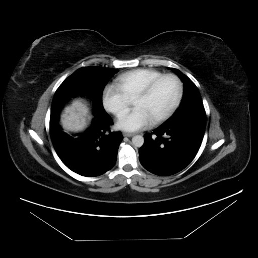 Breast cancer pseudocirrhosis after chemotherapy (Radiopaedia 65407-74457 A 4).jpg