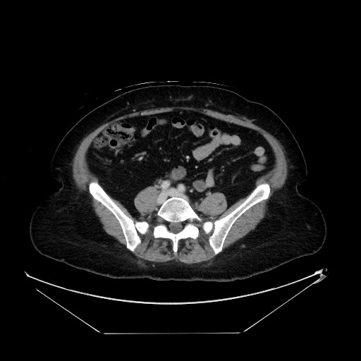 File:Breast cancer pseudocirrhosis with lobar invovlement (Radiopaedia 81080-94670 A 106).jpg