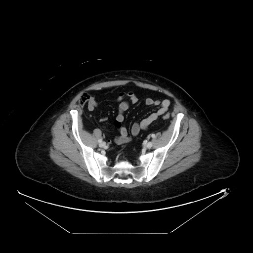 Breast cancer pseudocirrhosis with lobar invovlement (Radiopaedia 81080-94670 A 123).jpg