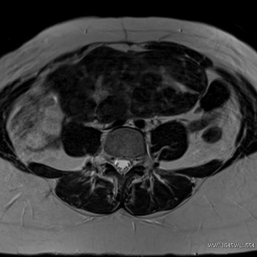 File:Broad ligament fibroid (Radiopaedia 49135-54241 Axial T2 4).jpg