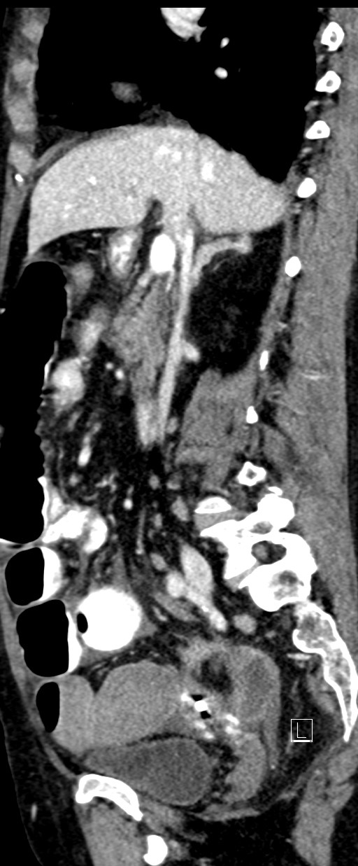 Broad ligament hernia (Radiopaedia 84802-100276 C 47).jpg