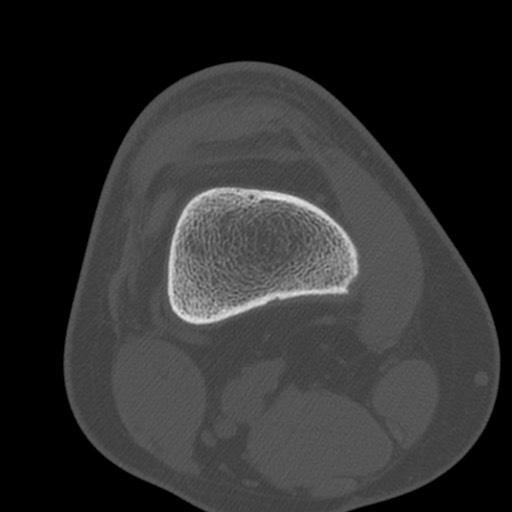 Brodie abscess of the tibia (Radiopaedia 58984-66250 Axial bone window 14).jpg