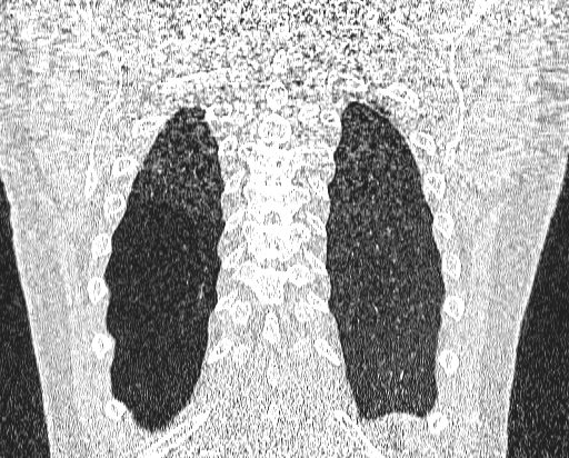 File:Bronchial atresia (Radiopaedia 58271-65417 Coronal lung window 52).jpg