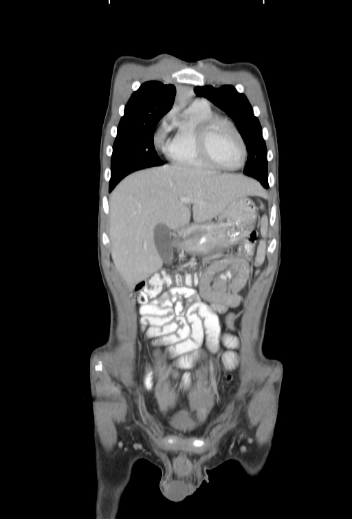 Bronchial carcinoid tumor (Radiopaedia 57187-64090 B 9).jpg