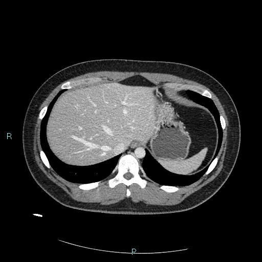 Bronchial carcinoid tumor (Radiopaedia 78272-90875 A 84).jpg