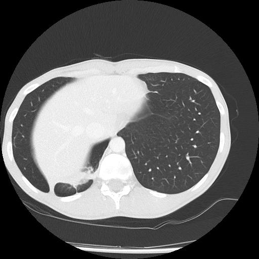 Bronchial carcinoid tumor causing right lower lobe collapse (Radiopaedia 83495-98594 Axial lung window 46).jpg