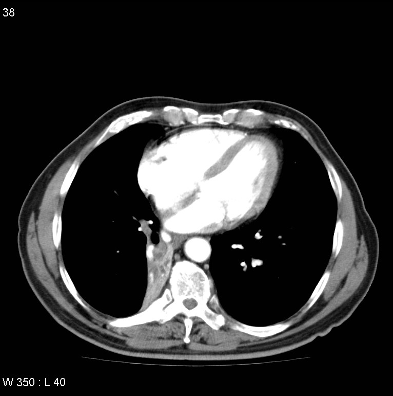 Bronchial carcinoid tumor with right lower lobe collapse (Radiopaedia 29060-29422 A 37).jpg