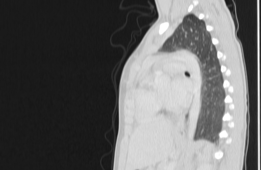 Bronchial mucoepidermoid carcinoma (Radiopaedia 57023-63895 Sagittal lung window 112).jpg