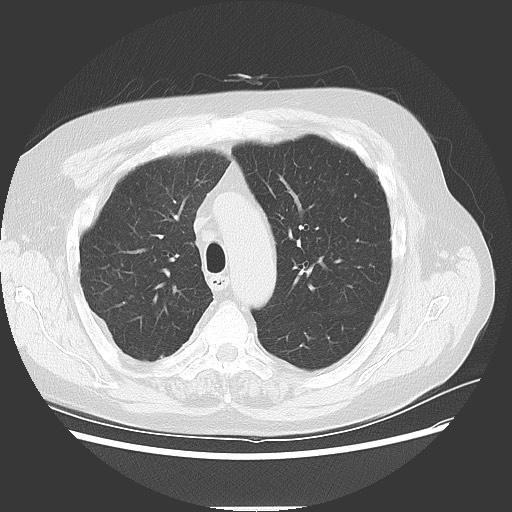 Bronchial stenosis - lung transplant (Radiopaedia 73133-83848 Axial lung window 20).jpg