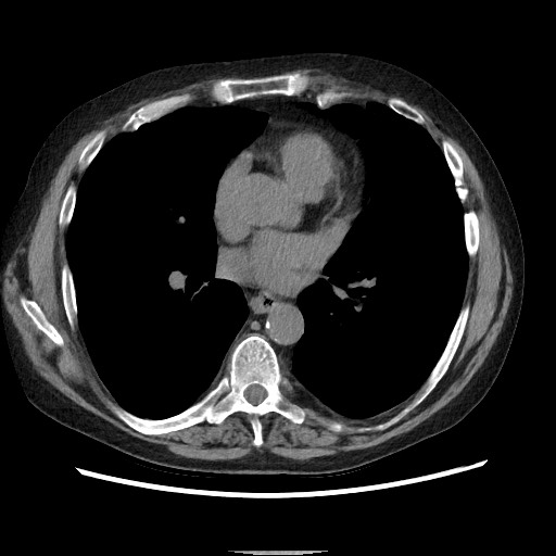 Bronchial stenosis - lung transplant (Radiopaedia 73133-83848 Axial non-contrast 36).jpg