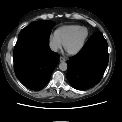 Bronchial stenosis - lung transplant (Radiopaedia 73133-83848 Axial non-contrast 46).jpg