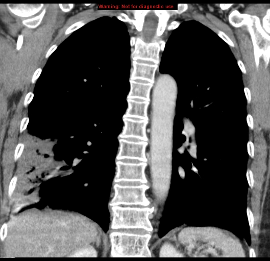 Bronchoalveolar carcinoma (BAC) (Radiopaedia 13436-13392 E 38).jpg