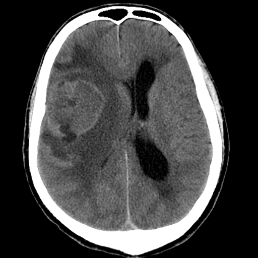 File:Bronchogenic carcinoma brain metastasis (Radiopaedia 9286-9970 Axial non-contrast 1).jpg