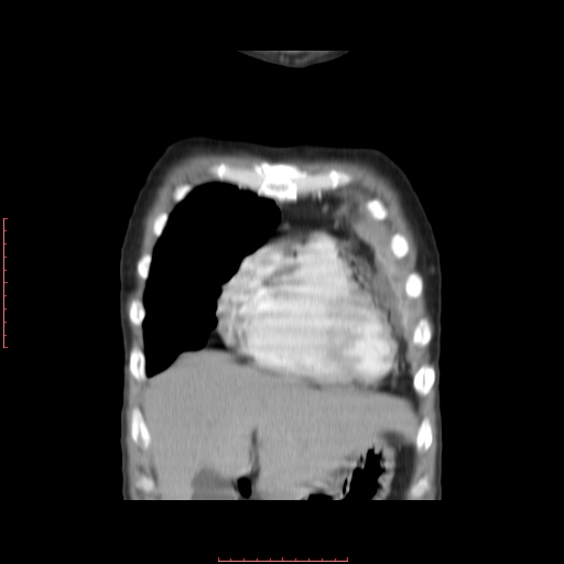 File:Bronchogenic carcinoma with left atrial large deposit - T4N3M1a (Radiopaedia 42316-45428 B 3).jpg