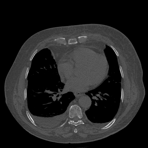 Bronchogenic carcinoma with metastatic lymphadenopathy (Radiopaedia 37671-39569 Axial bone window 35).jpg