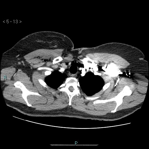 Bronchogenic cyst - posterior mediastinal (Radiopaedia 43885-47364 A 7).jpg