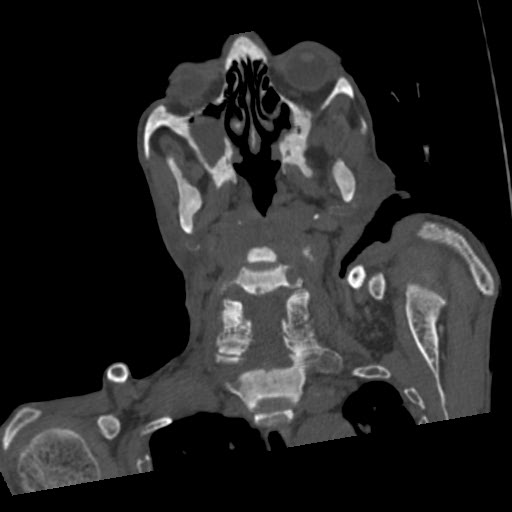 File:Brown tumor with secondary hyperparathyroidism (Radiopaedia 23591-23705 C 33).jpg