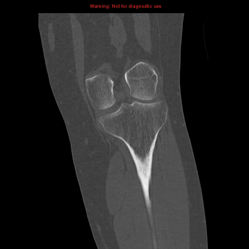File:Brown tumors (Radiopaedia 9666-10291 Coronal bone window 20).jpg