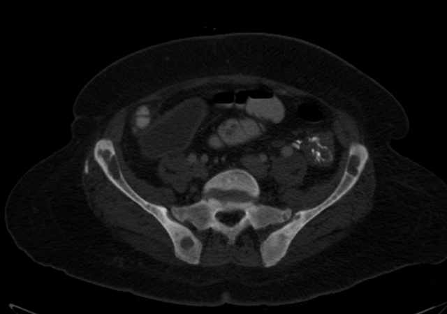Brown tumors compressing the spinal cord (Radiopaedia 68442-77988 G 92).jpg