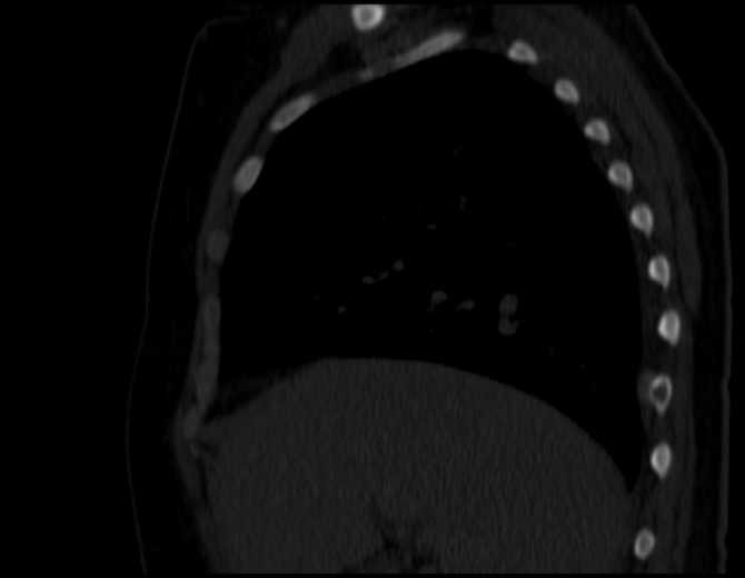 Brown tumors compressing the spinal cord (Radiopaedia 68442-77988 Sagittal bone window 19).jpg