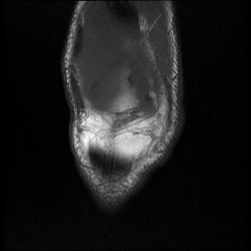 File:Bucket handle tear - medial meniscus (Radiopaedia 69245-79026 Coronal T1 3).jpg
