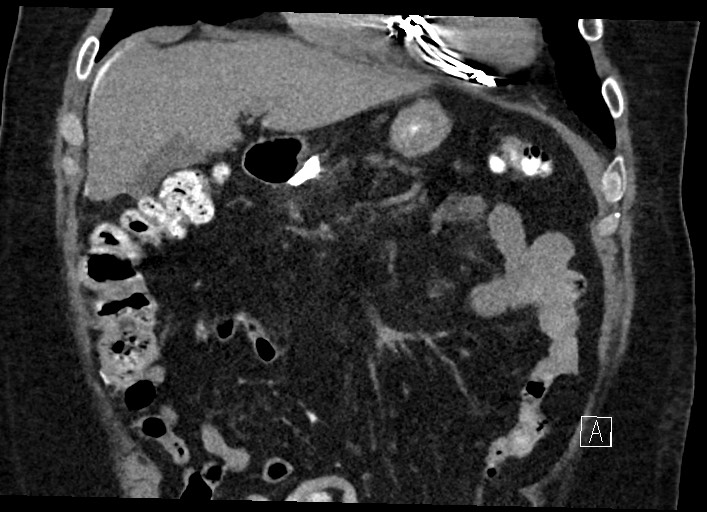 Buried bumper syndrome - gastrostomy tube (Radiopaedia 63843-72577 Coronal Inject 48).jpg