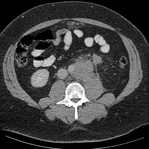 Burned-out testicular seminoma - retroperitoneal nodal metastases (Radiopaedia 62872-71245 A 41).jpg