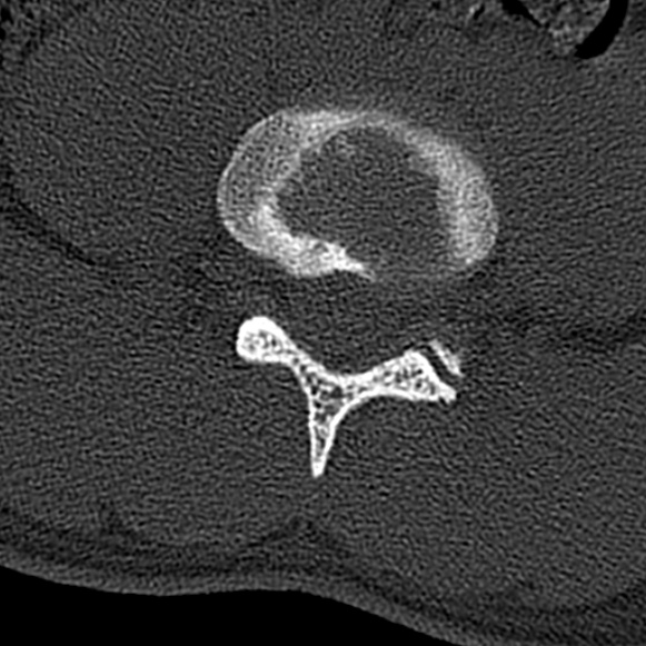 Burst fracture (Radiopaedia 53373-59357 Axial bone window 50).jpg