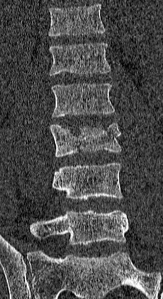 Burst fracture (Radiopaedia 53373-59357 Coronal bone window 34).jpg