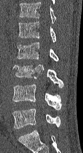 Burst fracture (Radiopaedia 53373-59357 Sagittal bone window 34).jpg
