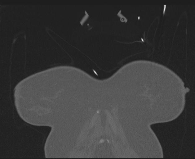Burst fracture - thoracic spine (Radiopaedia 30238-30865 Coronal bone window 10).jpg